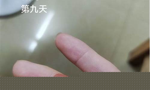 疣体掉了需要用草本抑菌液吗为什么引起的痒-使疣体脱落的药