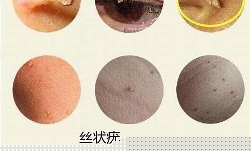 草本祛疣液-疣体掉了需要用草本抑菌液吗为什么检查