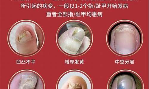 草本抑菌液可以治疗脚气吗?-草本抑菌液治疗甲沟炎