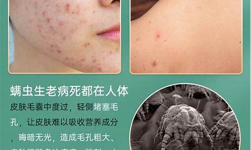 草本抑菌乳膏可以治身上痘痘吗-草本抑菌液可以祛痘吗为什么使用不了