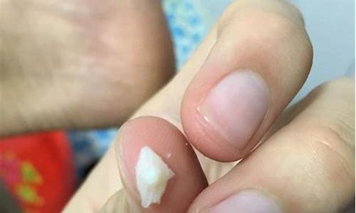 抑菌液能治疗疣吗-抑菌液的功效能治跖疣吗