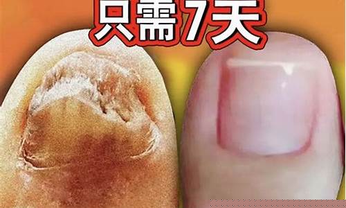 草本抑菌液对灰指甲有用吗是真的吗-草本抑菌液功能主治多少钱一瓶