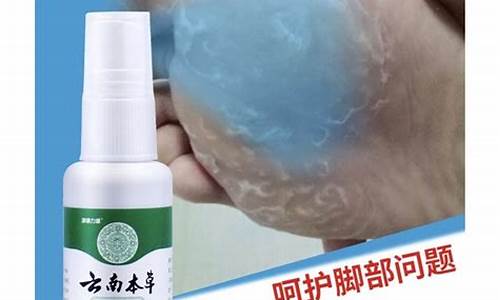 脚气能用草本抑菌液吗-脚气可以用草本小乳膏吗