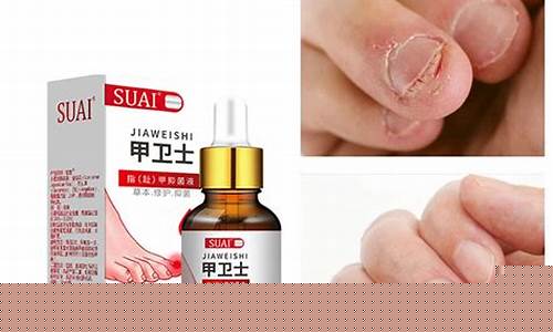 治疗灰指甲的草本抑菌液有哪些-治疗灰指甲的草本抑菌液有哪些药